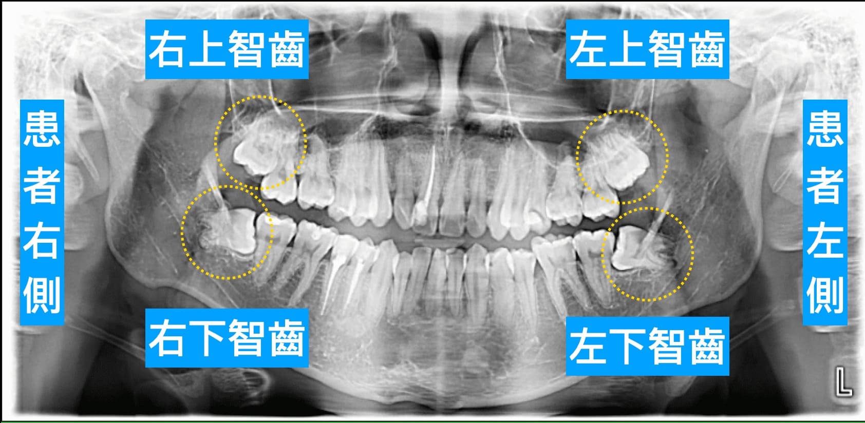 什麼是智齒